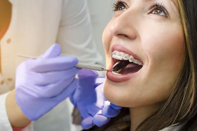 Las consecuencias negativas de los brackets dentales